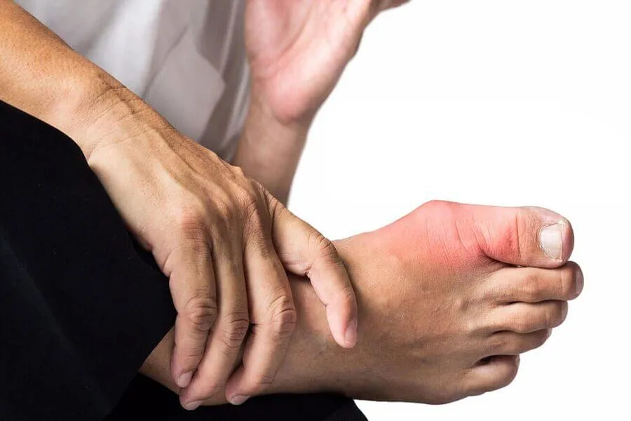 5 Dấu hiệu gout nhẹ mà người bệnh có thể phát hiện sớm