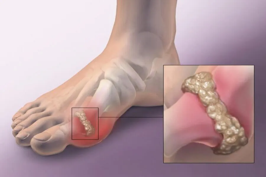 5 Dấu hiệu gout nhẹ mà người bệnh có thể phát hiện sớm