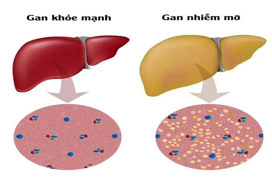 Bệnh gan nhiễm mỡ: Dấu hiệu, nguyên nhân và cách để phòng ngừa