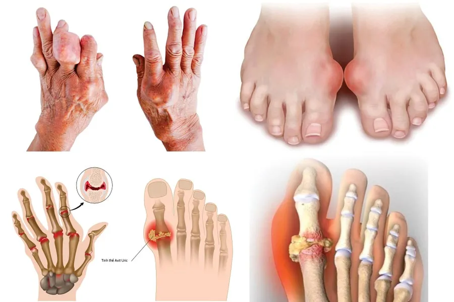 Bệnh gout có nguy hiểm không? Những biến chứng nguy hiểm