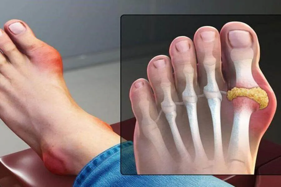 Bệnh Gout kiêng gì? Top 9 loại thực phẩm “đại kỵ”