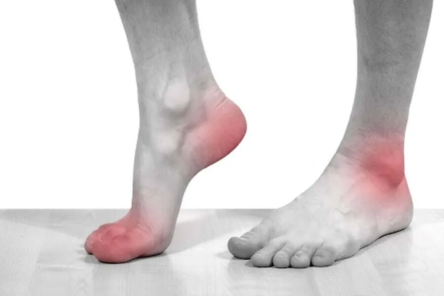 Bệnh gout là gì? Dấu hiệu của bệnh gout dễ nhận biết