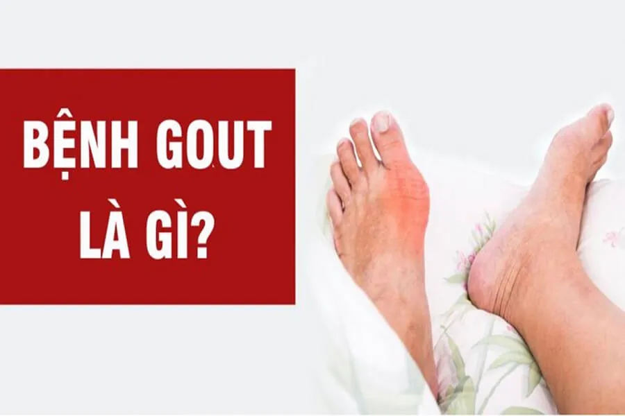 Bệnh Gút là gì? Giai đoạn đầu của bệnh gút