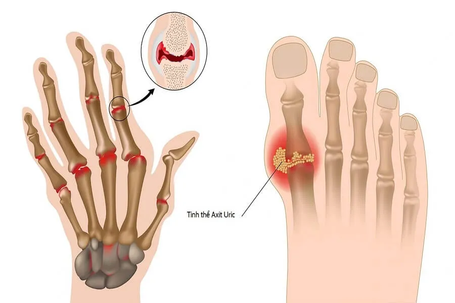 Bệnh Gút là gì? Giai đoạn đầu của bệnh gút