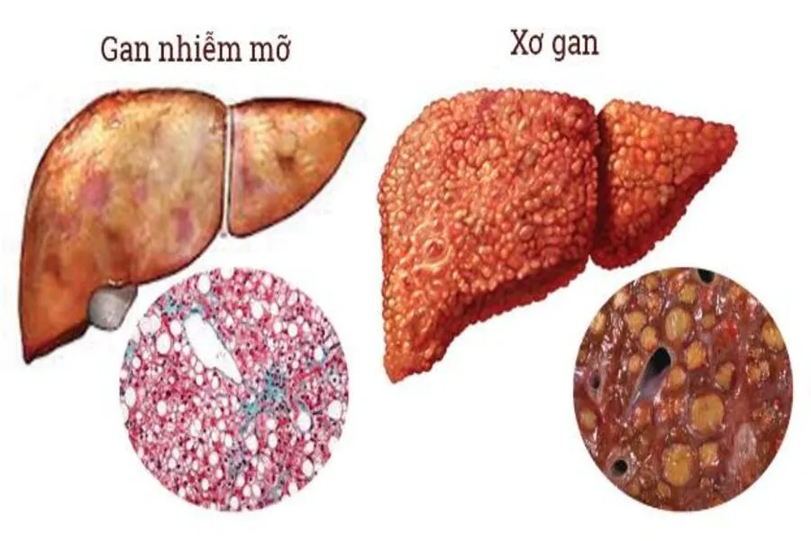 Bị gan nhiễm mỡ uống thuốc gì điều trị hiệu quả nhất?