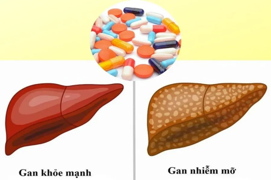 Bị gan nhiễm mỡ uống thuốc gì điều trị hiệu quả nhất?