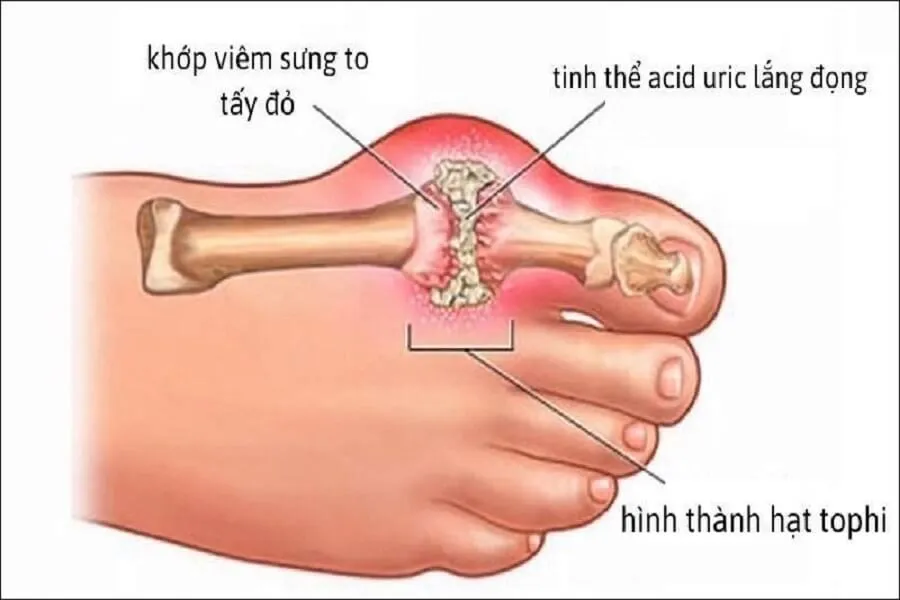 Bỏ túi 5 cách giảm đau gout nhanh nhất, cực hiệu quả