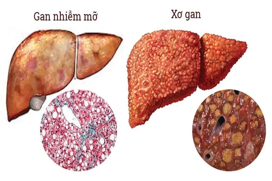 Gan nhiễm mỡ có nguy hiểm không? Phương pháp điều trị