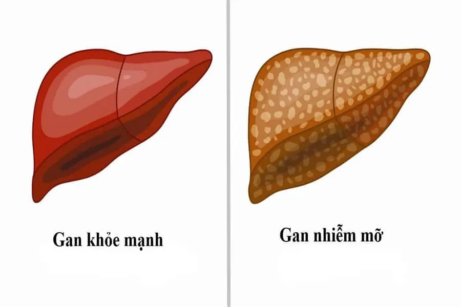 Gan nhiễm mỡ độ 1: Nguyên nhân và dấu hiệu nhận biết