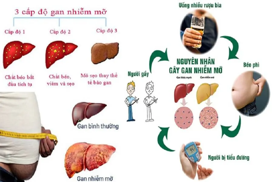 Gan nhiễm mỡ độ 1: Nguyên nhân và dấu hiệu nhận biết