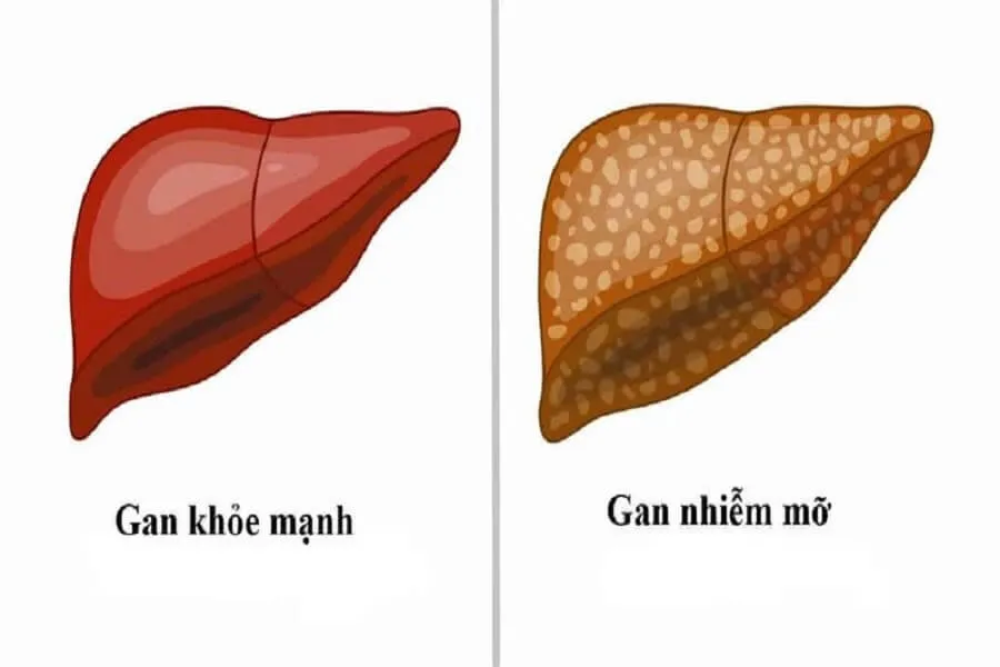 Gan nhiễm mỡ kiêng gì để cải thiện tình trạng bệnh?