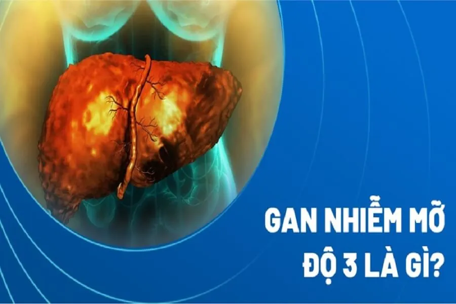 [Hỏi đáp] Gan nhiễm mỡ độ 3 có nguy hiểm không?