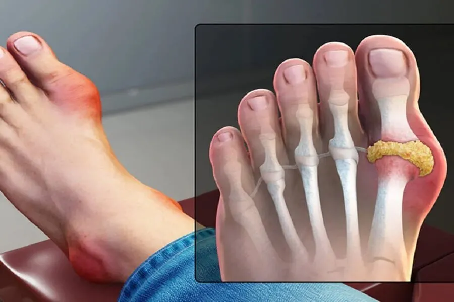 Nguyên nhân bị gout và cách điều trị hiệu quả