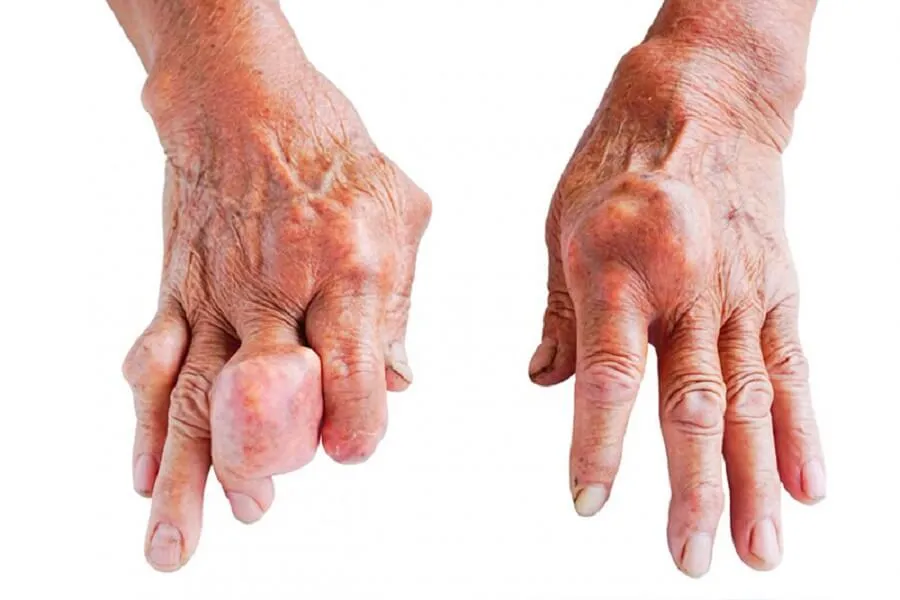 Nguyên nhân bị gout và cách điều trị hiệu quả