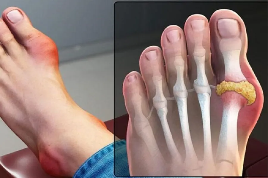 Những dấu hiệu bệnh gout qua các giai đoạn và mức độ nguy hiểm