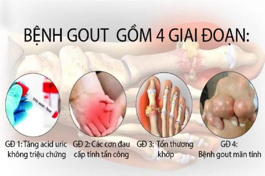 Những dấu hiệu bệnh gout qua các giai đoạn và mức độ nguy hiểm